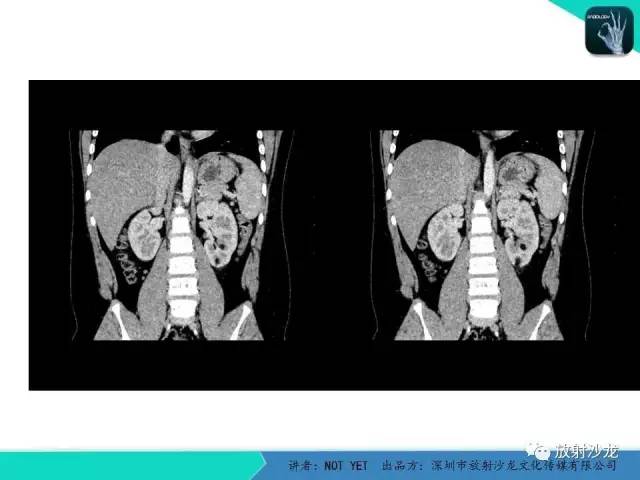 【病例】肾脏血管平滑肌脂肪瘤1例CT影像表现