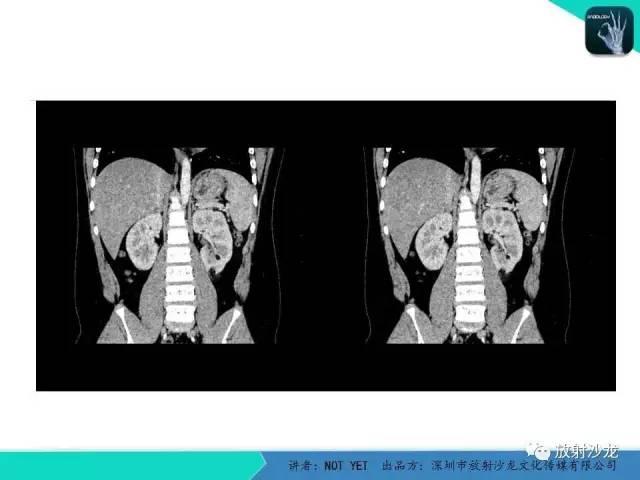【病例】肾脏血管平滑肌脂肪瘤1例CT影像表现