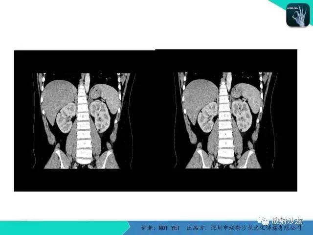 【病例】肾脏血管平滑肌脂肪瘤1例CT影像表现