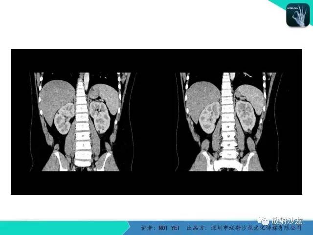 【病例】肾脏血管平滑肌脂肪瘤1例CT影像表现