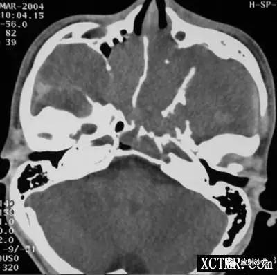 【病例】巨大鼻咽纤维血管瘤1例CT影像表现 【病例】巨大鼻咽纤维血管瘤1例CT影像表现