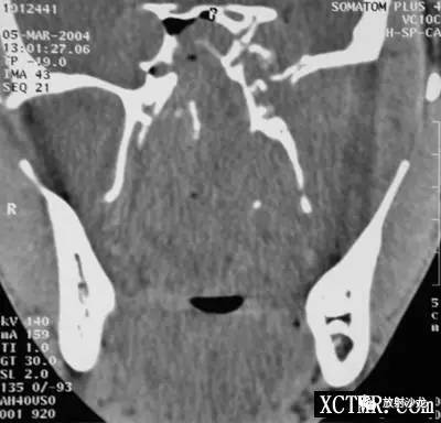 【病例】巨大鼻咽纤维血管瘤1例CT影像表现 【病例】巨大鼻咽纤维血管瘤1例CT影像表现