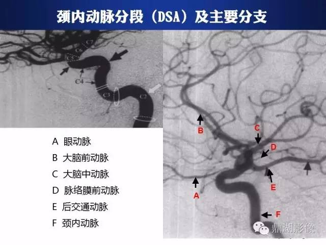 颅内动脉解剖详解
