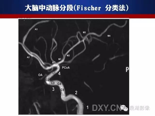 颅内动脉解剖详解