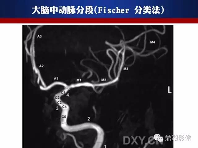 颅内动脉解剖详解