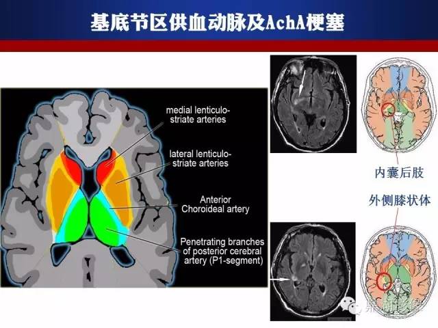 颅内动脉解剖详解