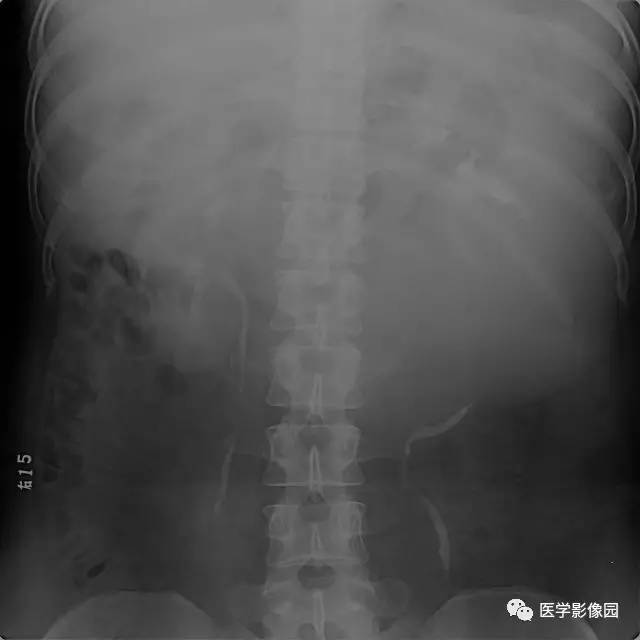 【病例】原发性肾肉瘤1例CT