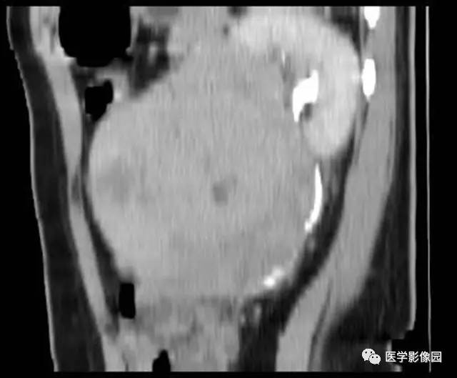 【病例】原发性肾肉瘤1例CT