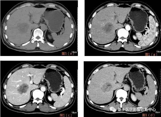 【病例】肝肉瘤样癌1例CT