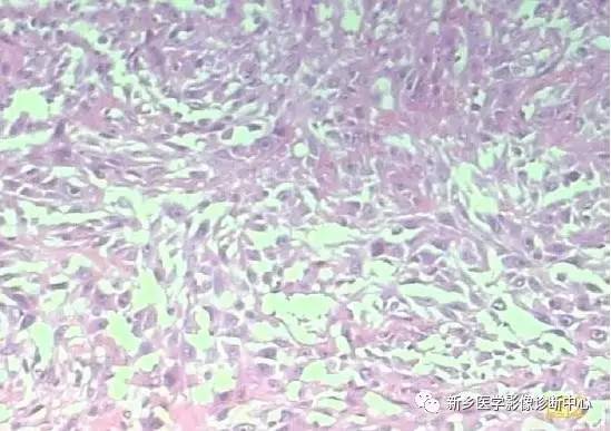 【病例】肝肉瘤样癌1例CT 【病例】肝肉瘤样癌1例CT