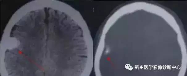 颅内钙化性的病变,你应该想到的19种肿瘤 颅内钙化性的病变,你应该想到的19种肿瘤