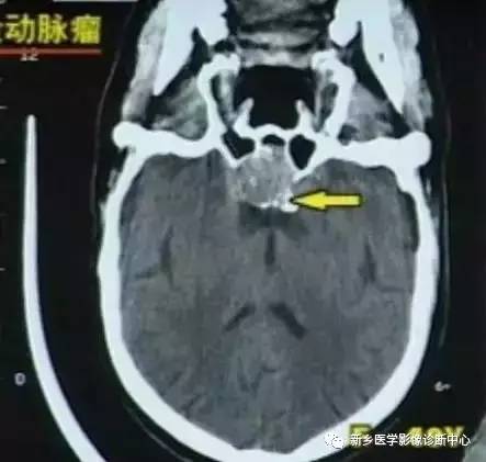 颅内钙化性的病变,你应该想到的19种肿瘤 颅内钙化性的病变,你应该想到的19种肿瘤