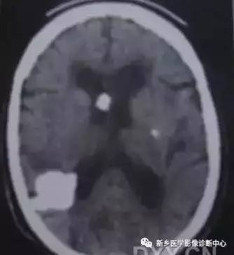 颅内钙化性的病变,你应该想到的19种肿瘤 颅内钙化性的病变,你应该想到的19种肿瘤