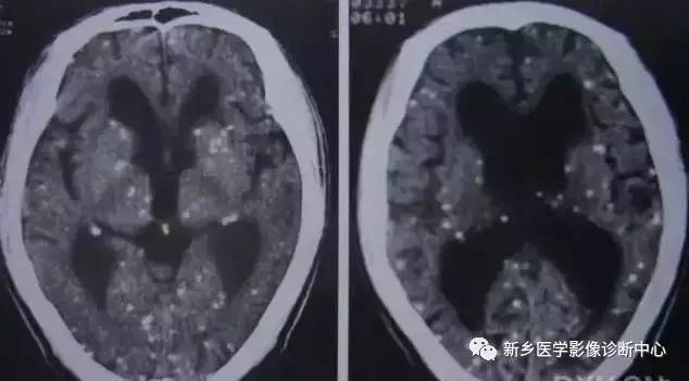 颅内钙化性的病变,你应该想到的19种肿瘤 颅内钙化性的病变,你应该想到的19种肿瘤