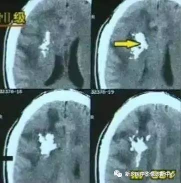 颅内钙化性的病变,你应该想到的19种肿瘤 颅内钙化性的病变,你应该想到的19种肿瘤