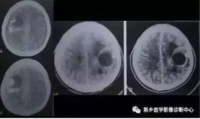 颅内钙化性的病变,你应该想到的19种肿瘤 颅内钙化性的病变,你应该想到的19种肿瘤