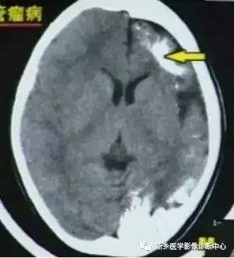 颅内钙化性的病变,你应该想到的19种肿瘤 颅内钙化性的病变,你应该想到的19种肿瘤