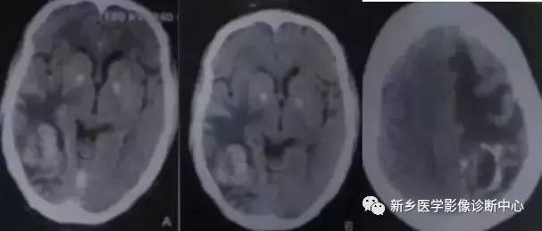 颅内钙化性的病变,你应该想到的19种肿瘤 颅内钙化性的病变,你应该想到的19种肿瘤