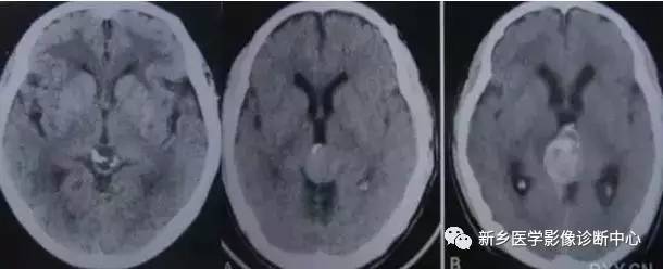 颅内钙化性的病变,你应该想到的19种肿瘤 颅内钙化性的病变,你应该想到的19种肿瘤