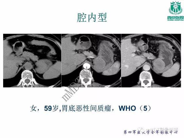 【PPT】胃肠道间质瘤