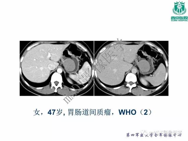 【PPT】胃肠道间质瘤