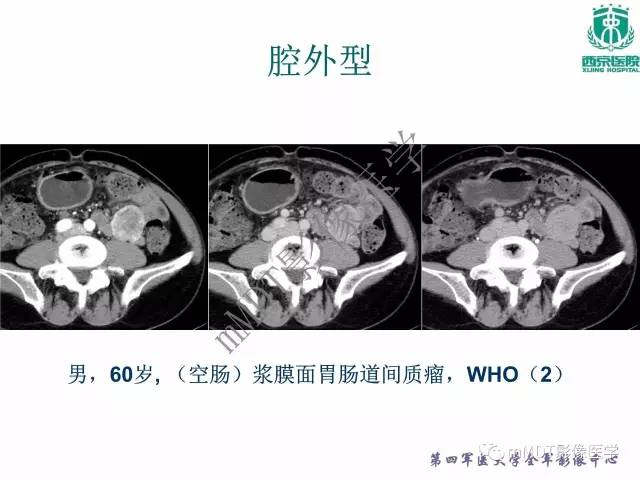 【PPT】胃肠道间质瘤