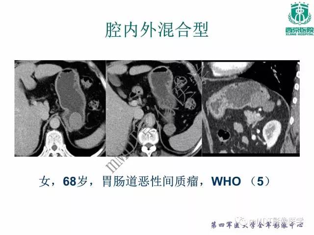 【PPT】胃肠道间质瘤