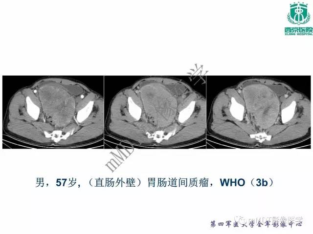 【PPT】胃肠道间质瘤