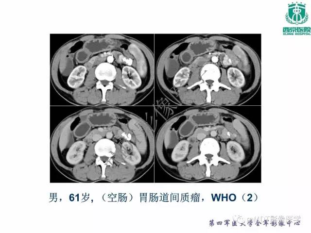 【PPT】胃肠道间质瘤
