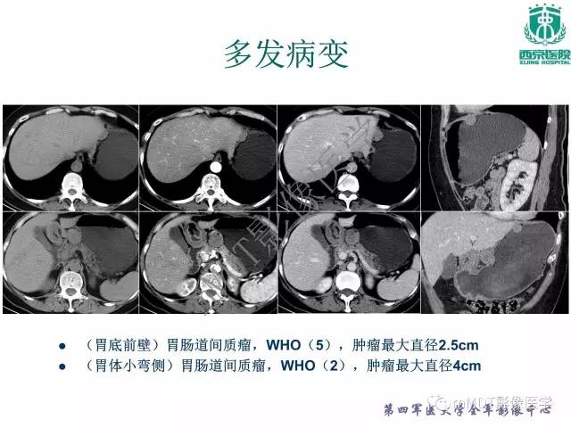【PPT】胃肠道间质瘤