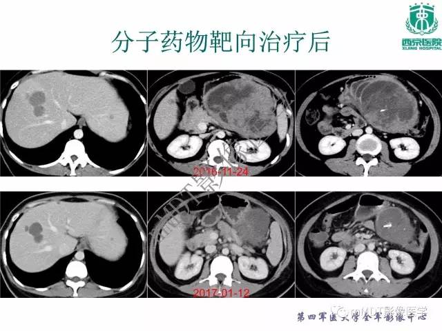 【PPT】胃肠道间质瘤