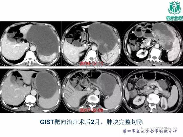 【PPT】胃肠道间质瘤