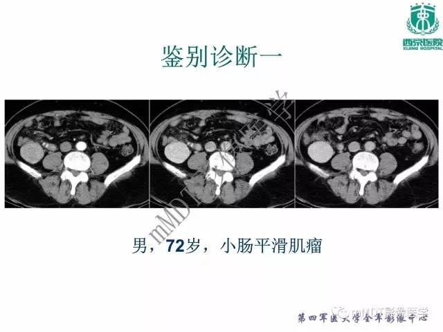 【PPT】胃肠道间质瘤