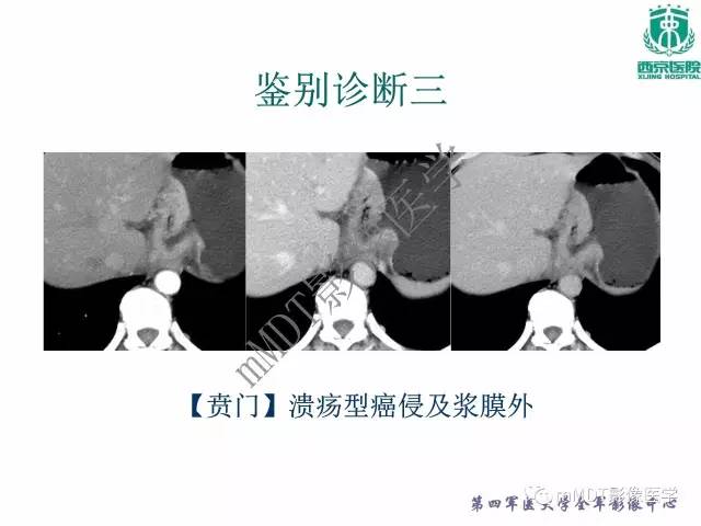 【PPT】胃肠道间质瘤