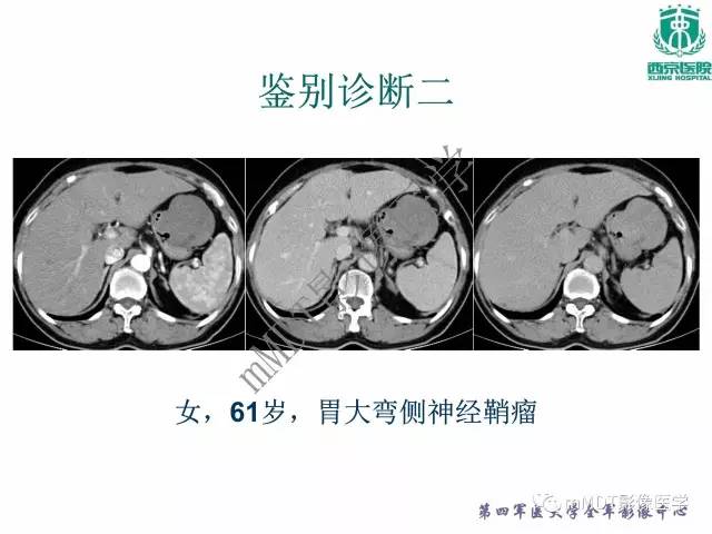 【PPT】胃肠道间质瘤