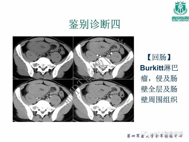 【PPT】胃肠道间质瘤