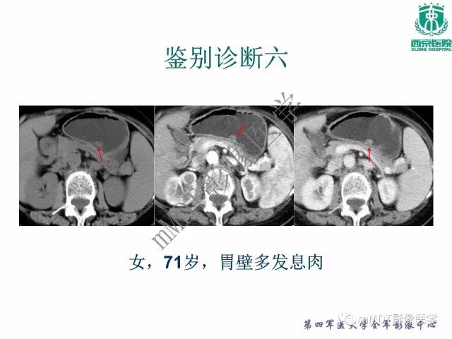 【PPT】胃肠道间质瘤