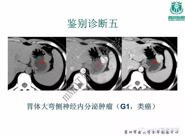 【PPT】胃肠道间质瘤