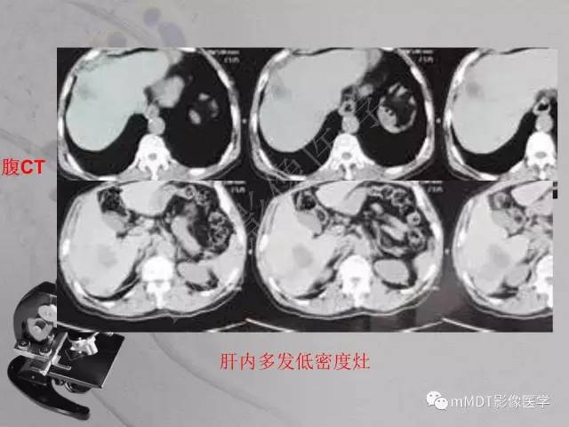 【PPT】脑干周围高信号，转移？免疫？ 一个远未解决的问题