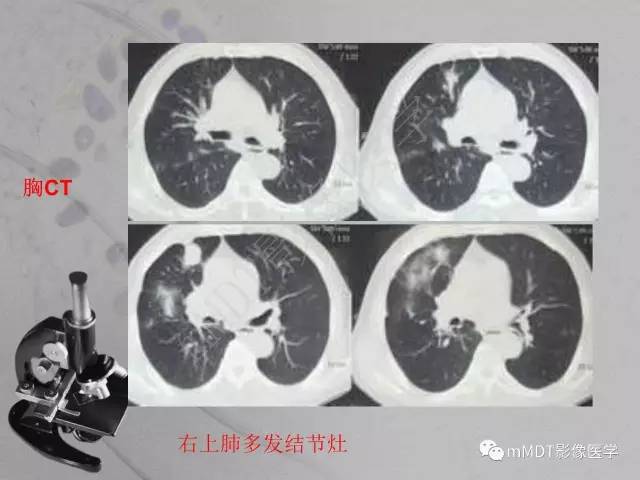 【PPT】脑干周围高信号，转移？免疫？ 一个远未解决的问题