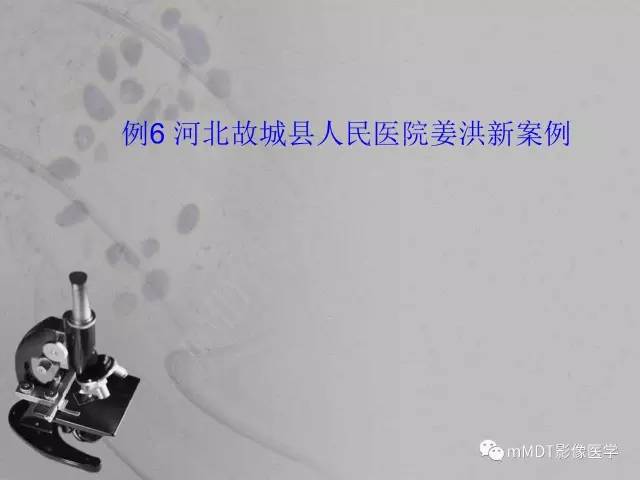 【PPT】脑干周围高信号，转移？免疫？ 一个远未解决的问题