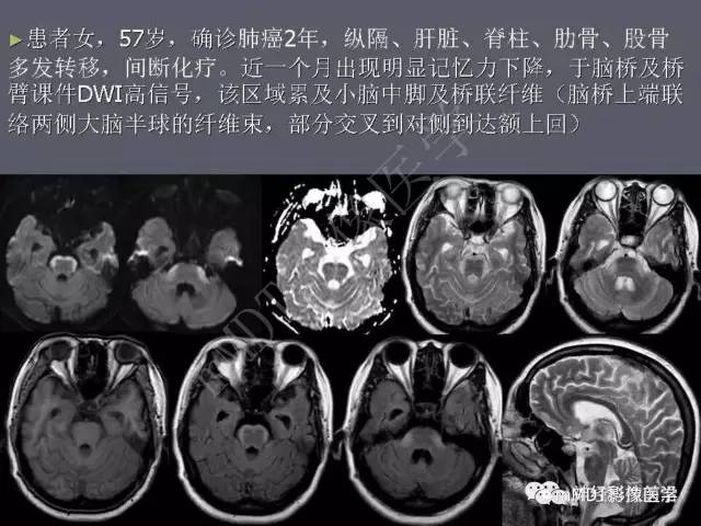 【PPT】脑干周围高信号，转移？免疫？ 一个远未解决的问题