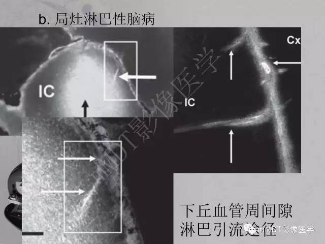 【PPT】脑干周围高信号，转移？免疫？ 一个远未解决的问题