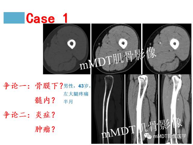 【PPT】骨感染性病变的诊断思路