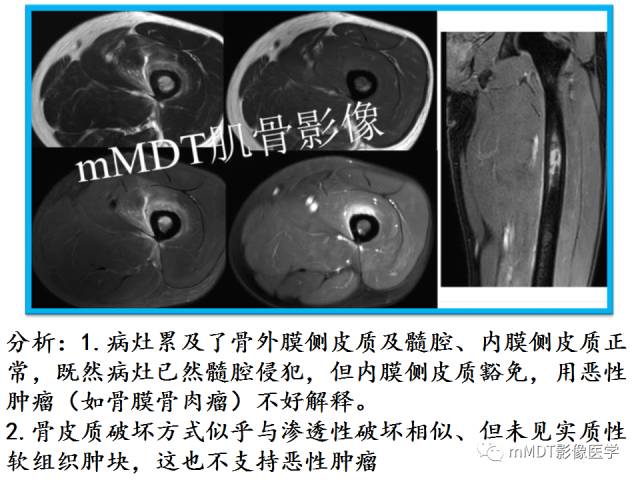 【PPT】骨感染性病变的诊断思路