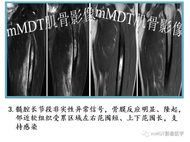 【PPT】骨感染性病变的诊断思路