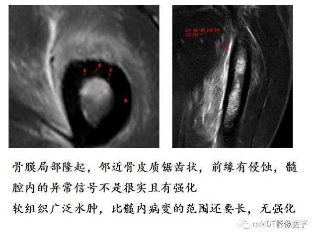 【PPT】骨感染性病变的诊断思路