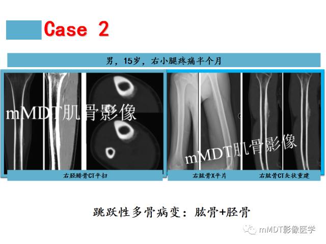 【PPT】骨感染性病变的诊断思路