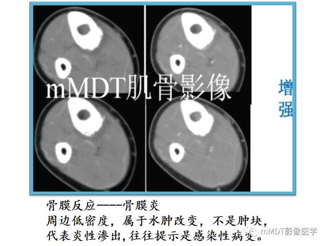 【PPT】骨感染性病变的诊断思路