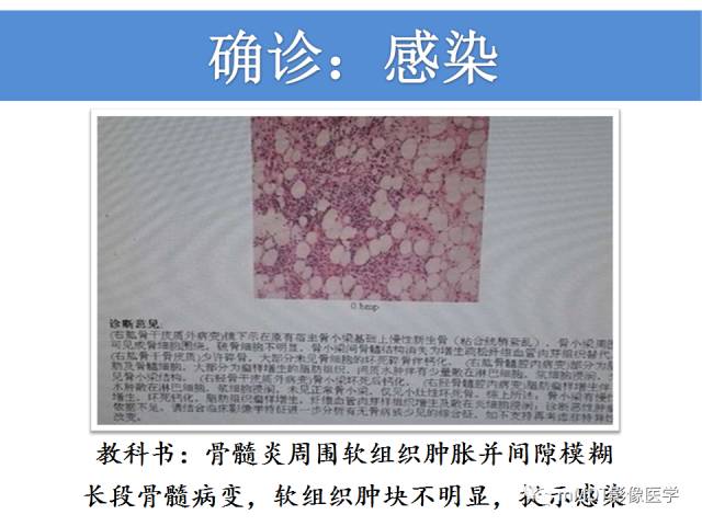 【PPT】骨感染性病变的诊断思路